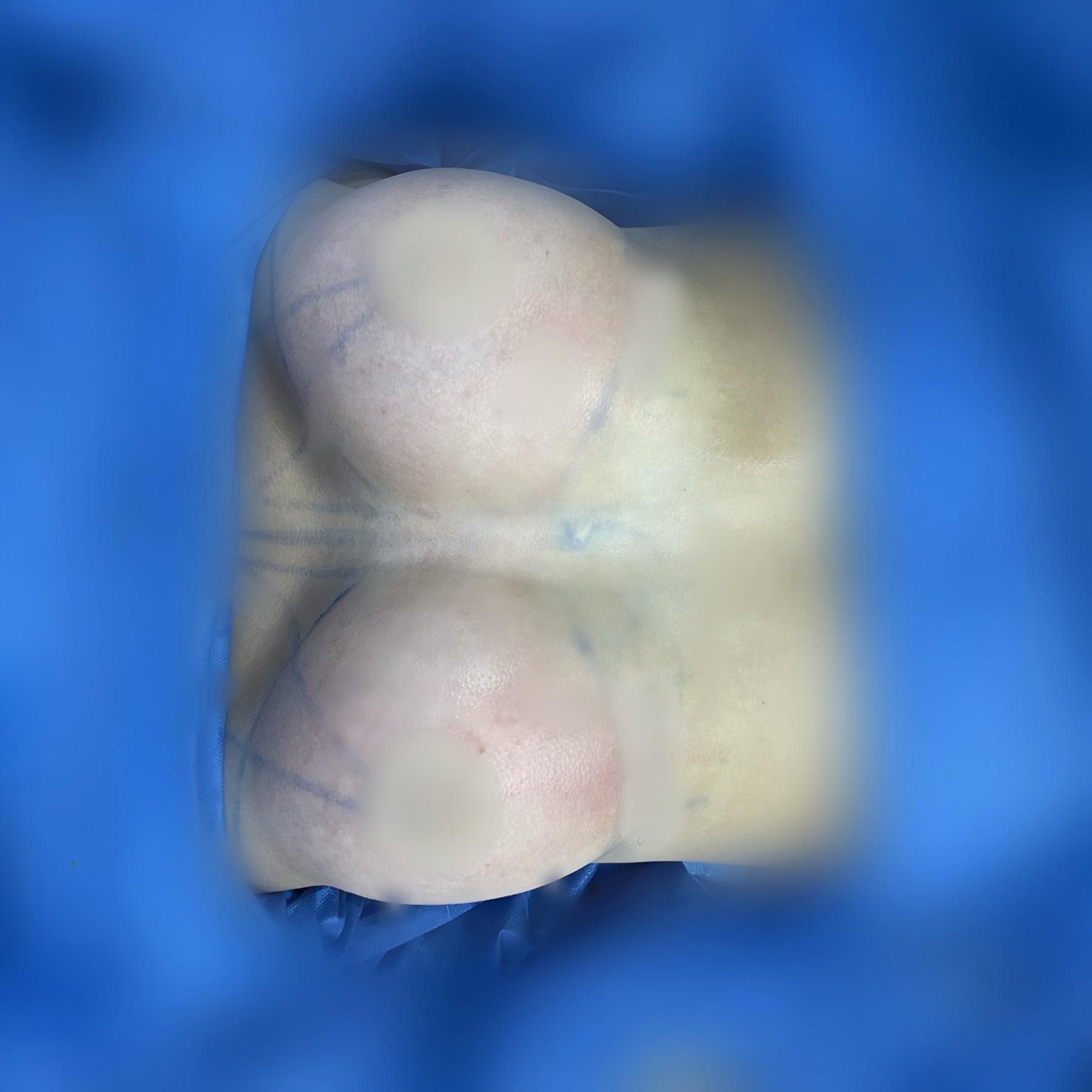 Clinical breast surgery result with privacy protected