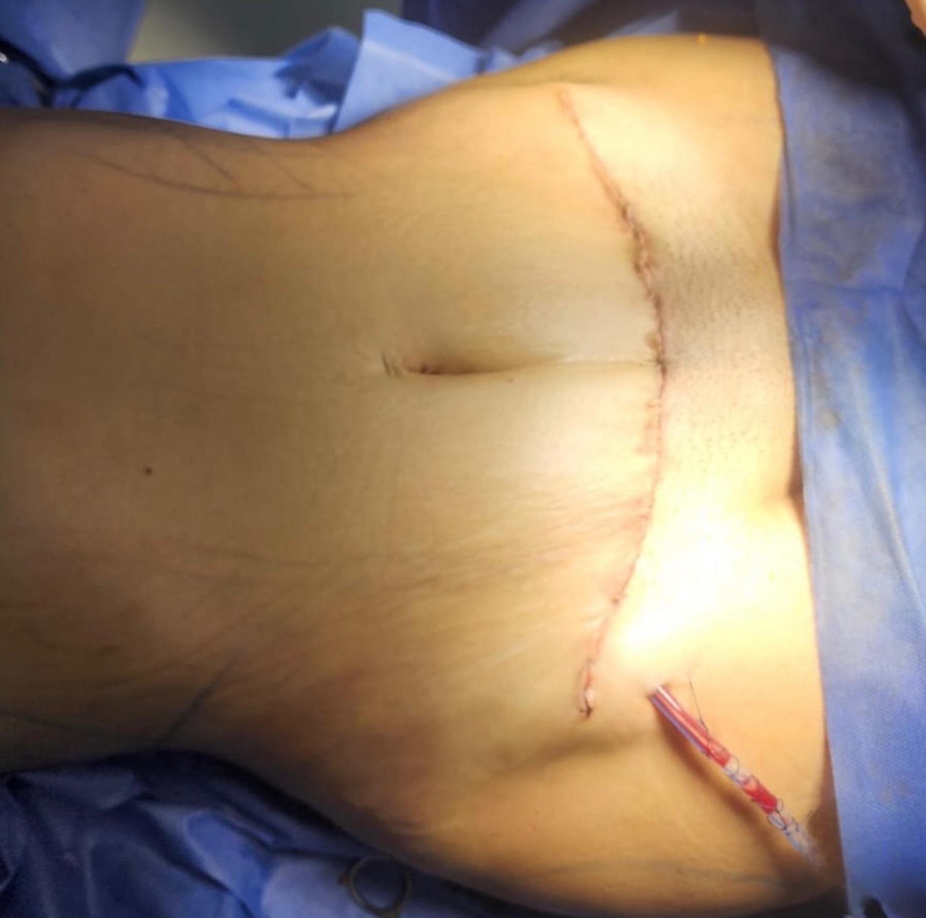 Preoperative abdominal markings
