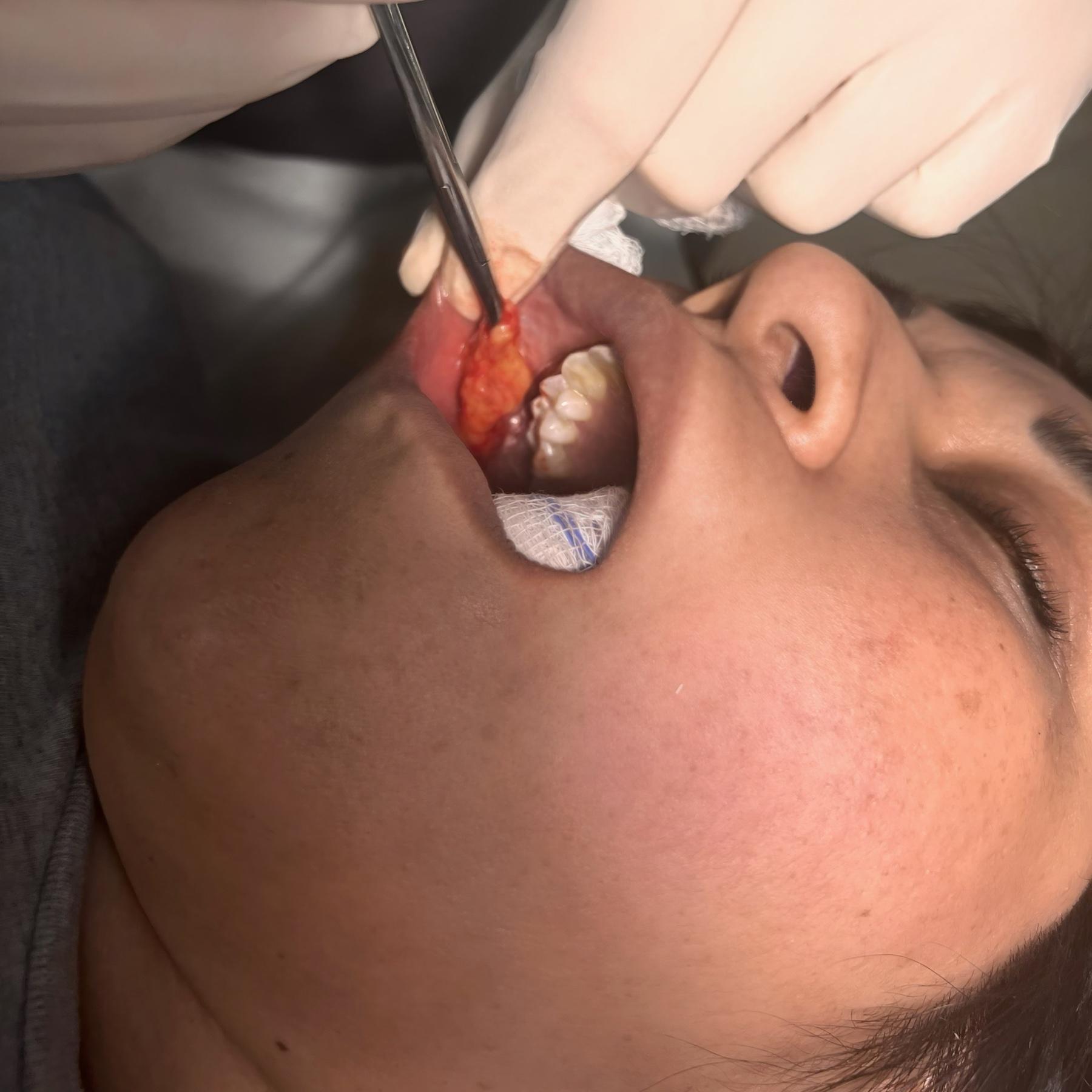 Buccal fat removal procedure in a surgical setting