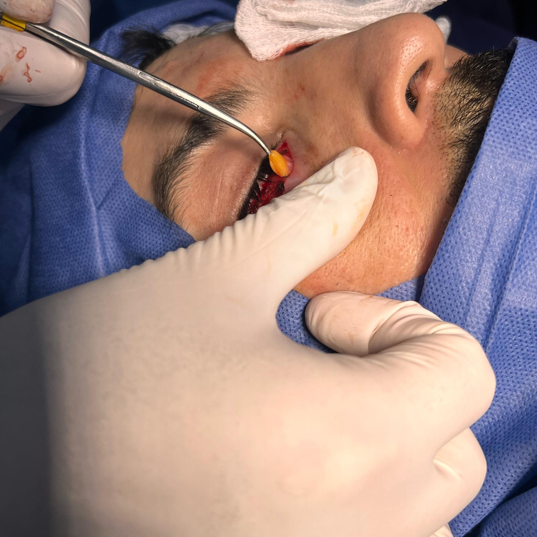 Clinical eyelid surgery comparison