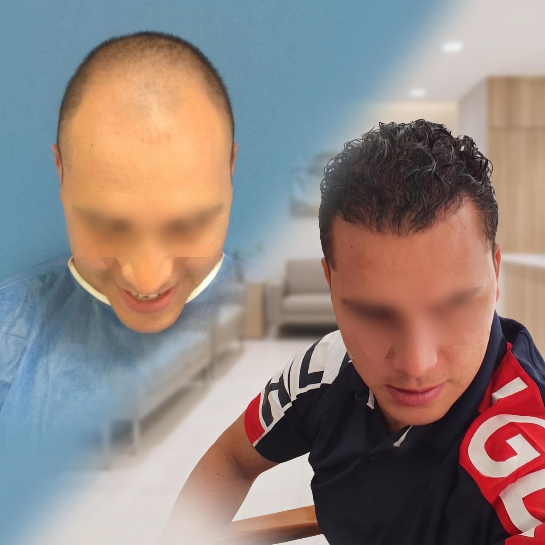 Clinical hair transplant comparison with identity protected