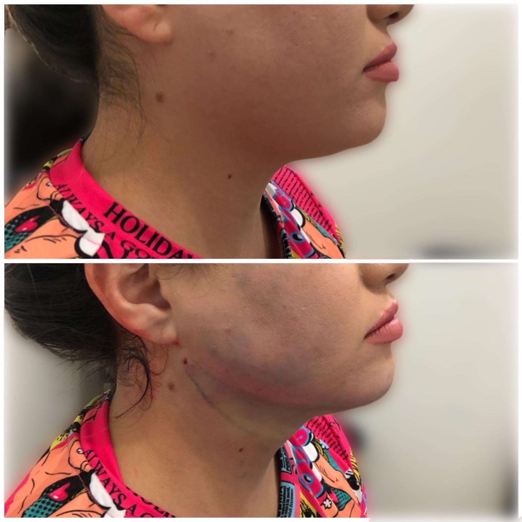 Clinical face and chin liposuction comparison