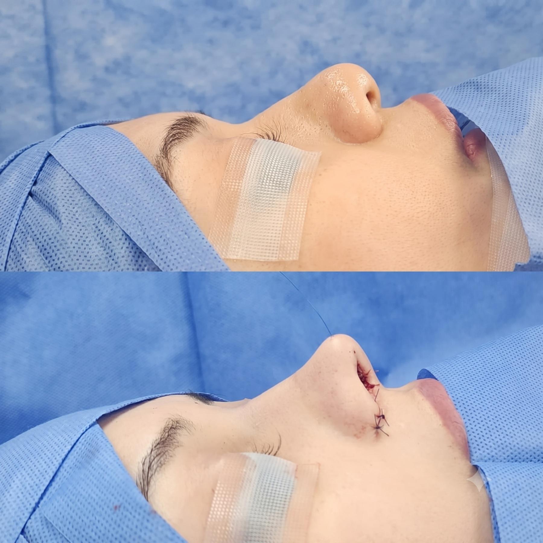 Clinical nasal profile comparison during rhinoplasty